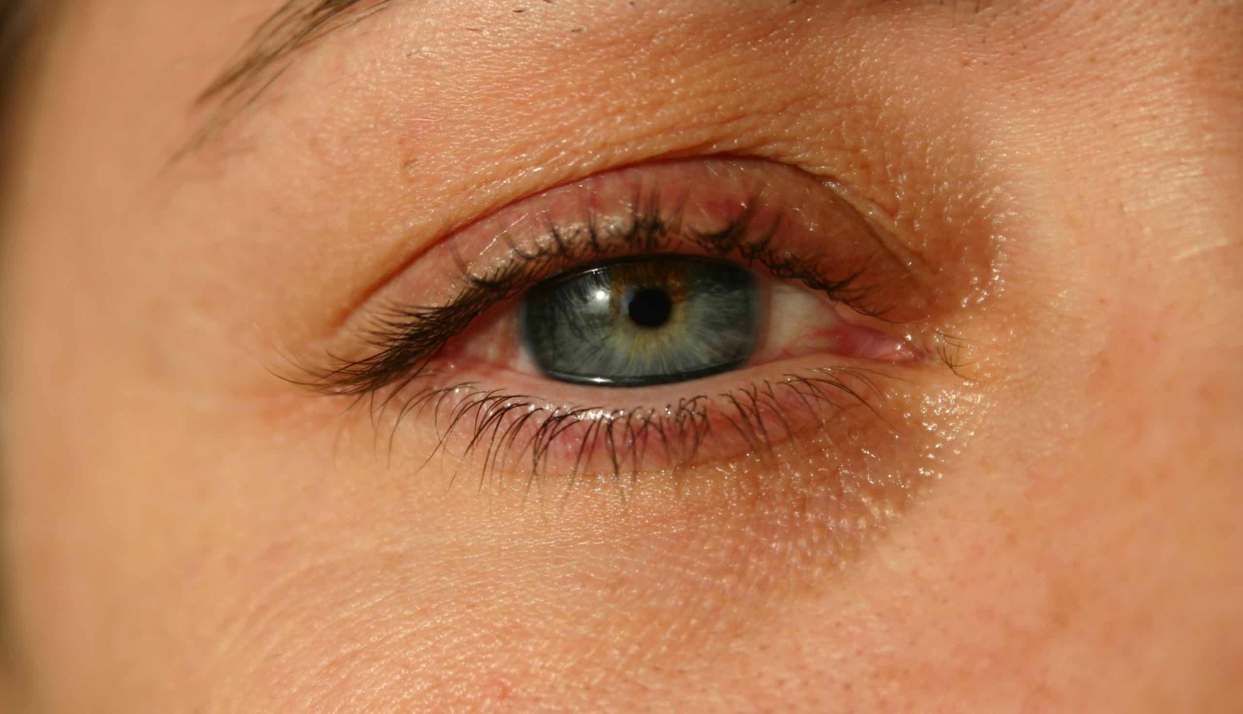 Conjunctivitis symptoms